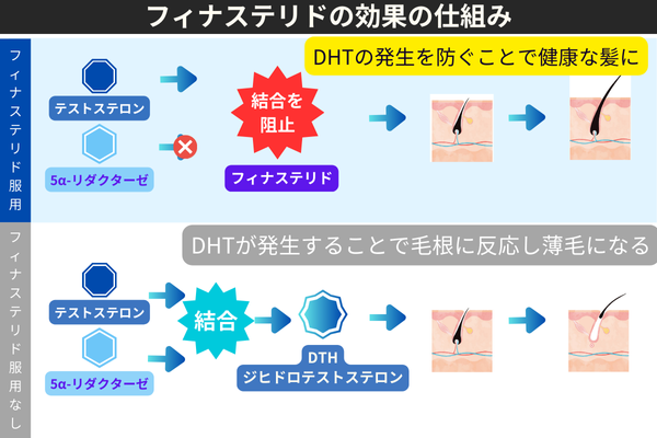 フィナステリドの効果の仕組み